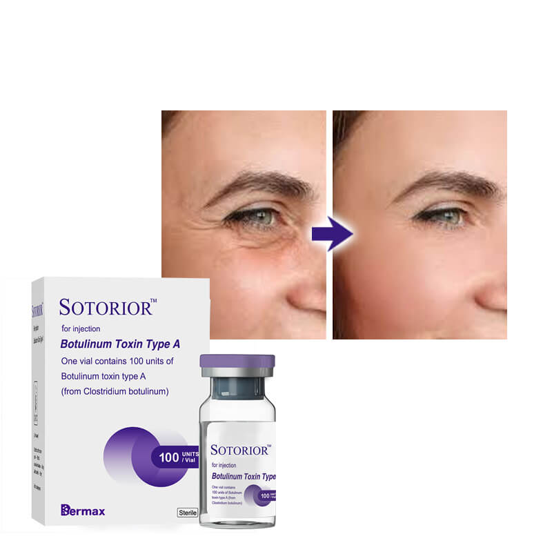 Botulinum Toxin Injection Technique Optimization for Facial Aesthetics