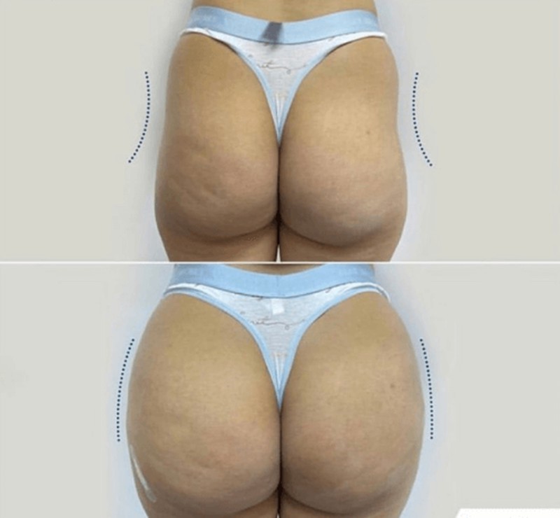 plla buttock filler injections before and after