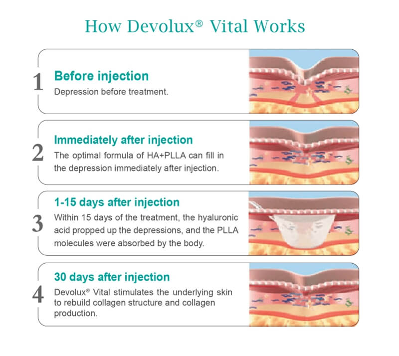 how plla ha dermal filler injection work