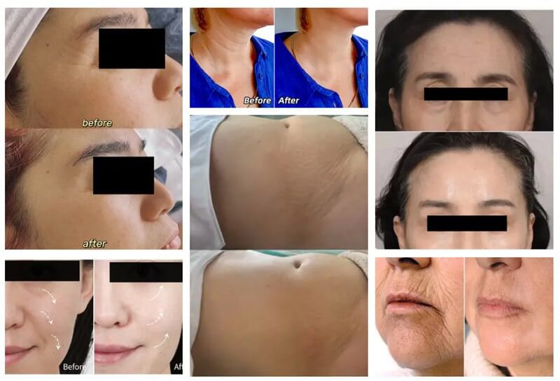 poly l lactic acid injection before and after