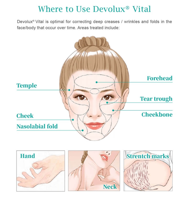 plla ha dermal filler injection treatment areas