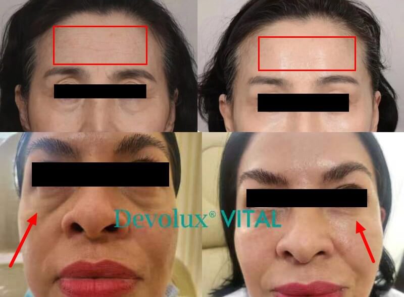 plla injection filler face before and after