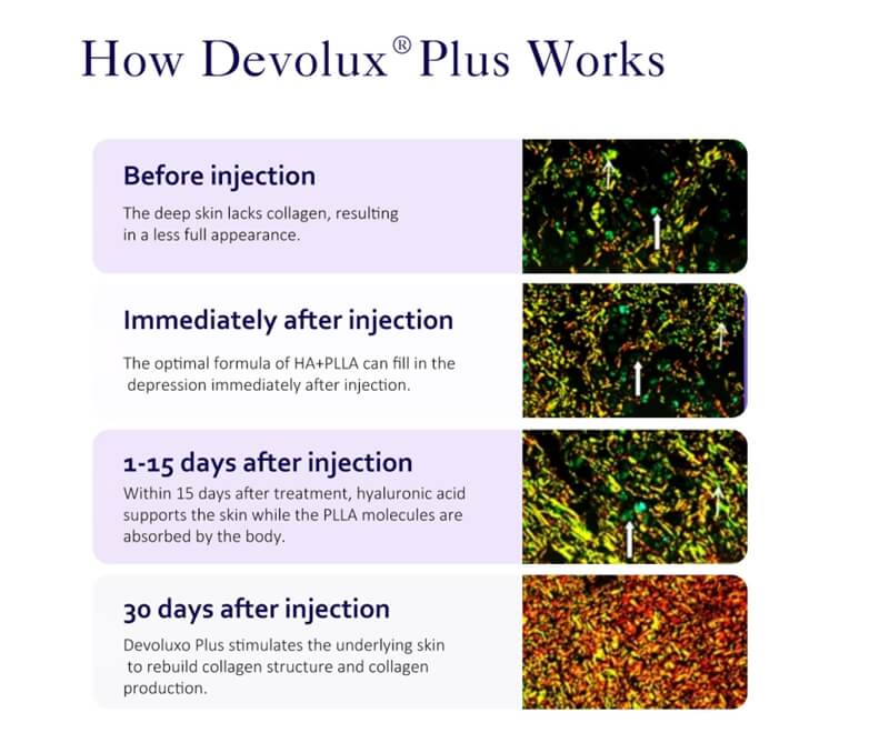how devolux plla breast enlargement works