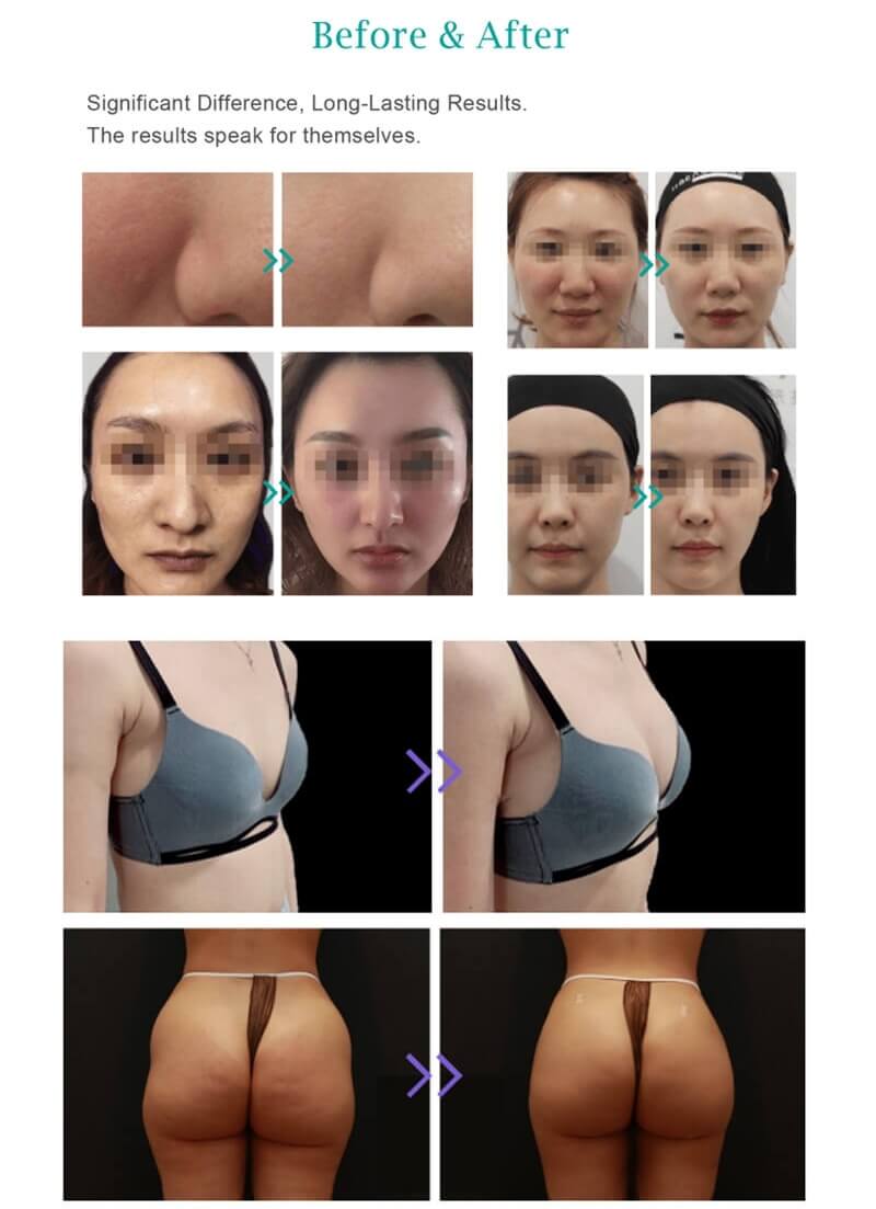 devolux plla filler before and after