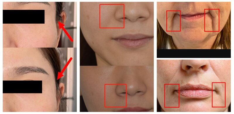 devolux plla filler before and after