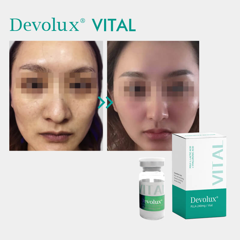 biostimulator injections before and after