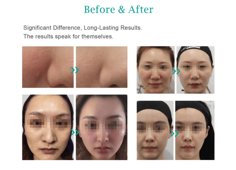 plla face before and after