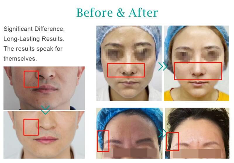 how long does plla filler last