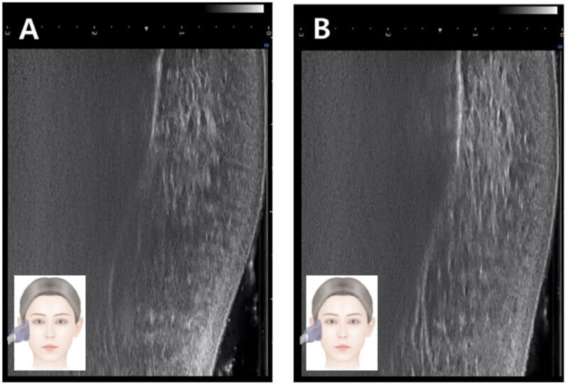 Ultrasound images before and after zygomatic ligament treatment