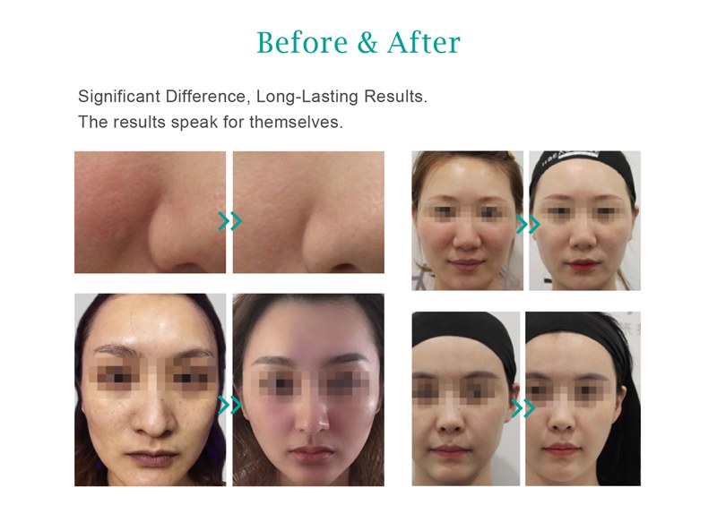 biostimulator injections before and after