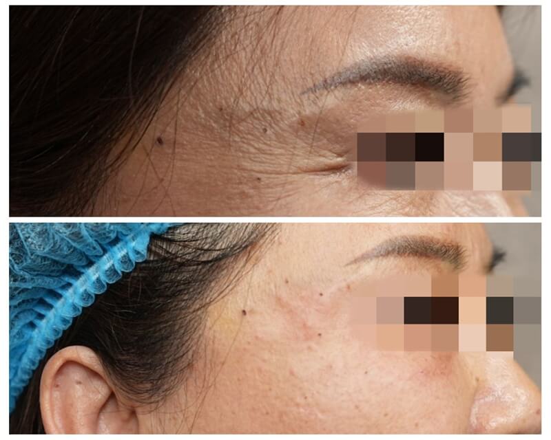 is devolux plla better than sotorior botulinum toxin