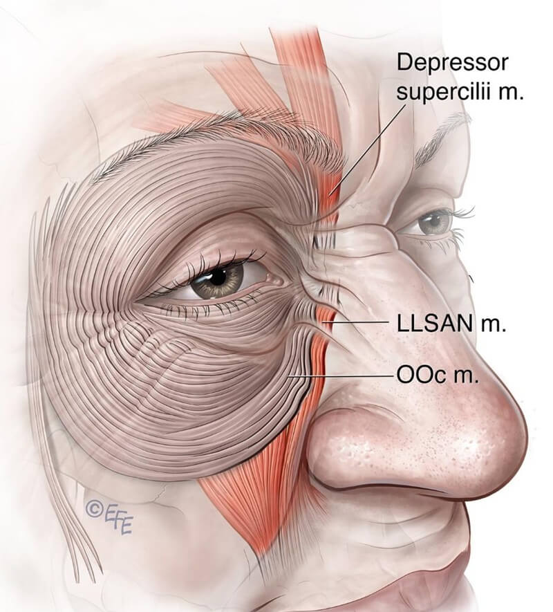 LLSAN and orbicularis oculi anatomical link
