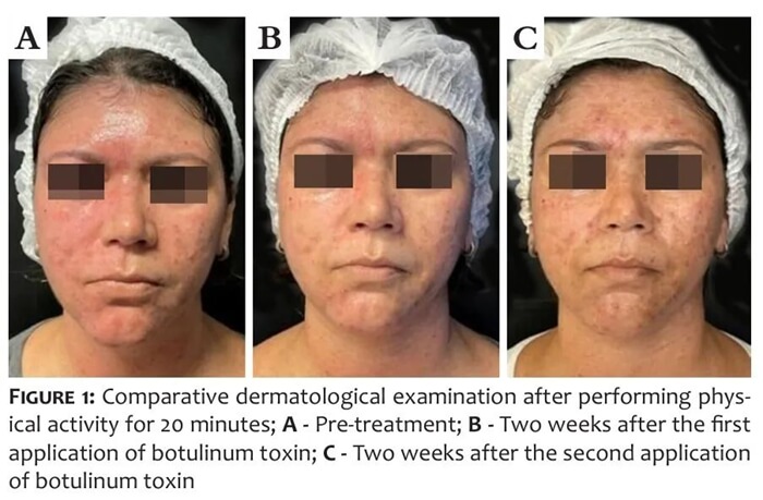 Harlequin syndrome treatment with botulinum toxin