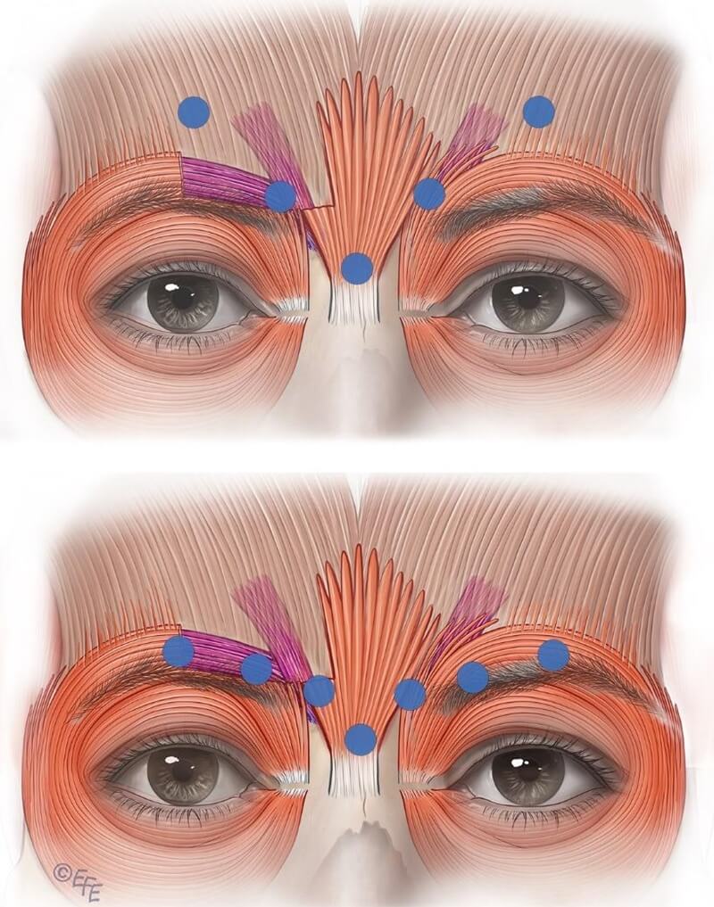 Restricted diffusion technique for corrugator