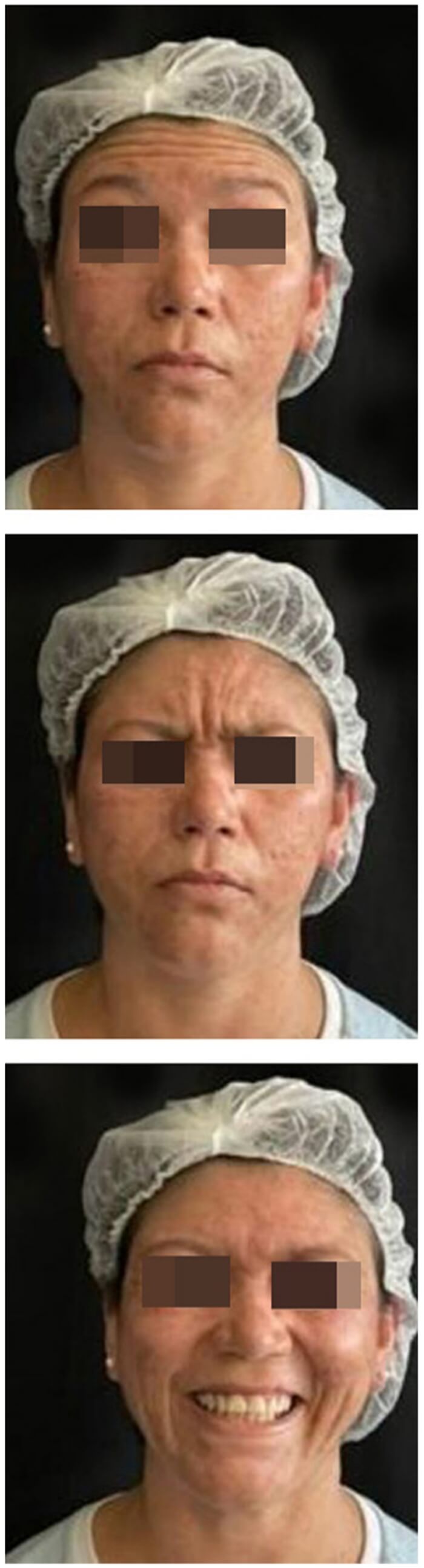 Harlequin syndrome treatment with botulinum toxin