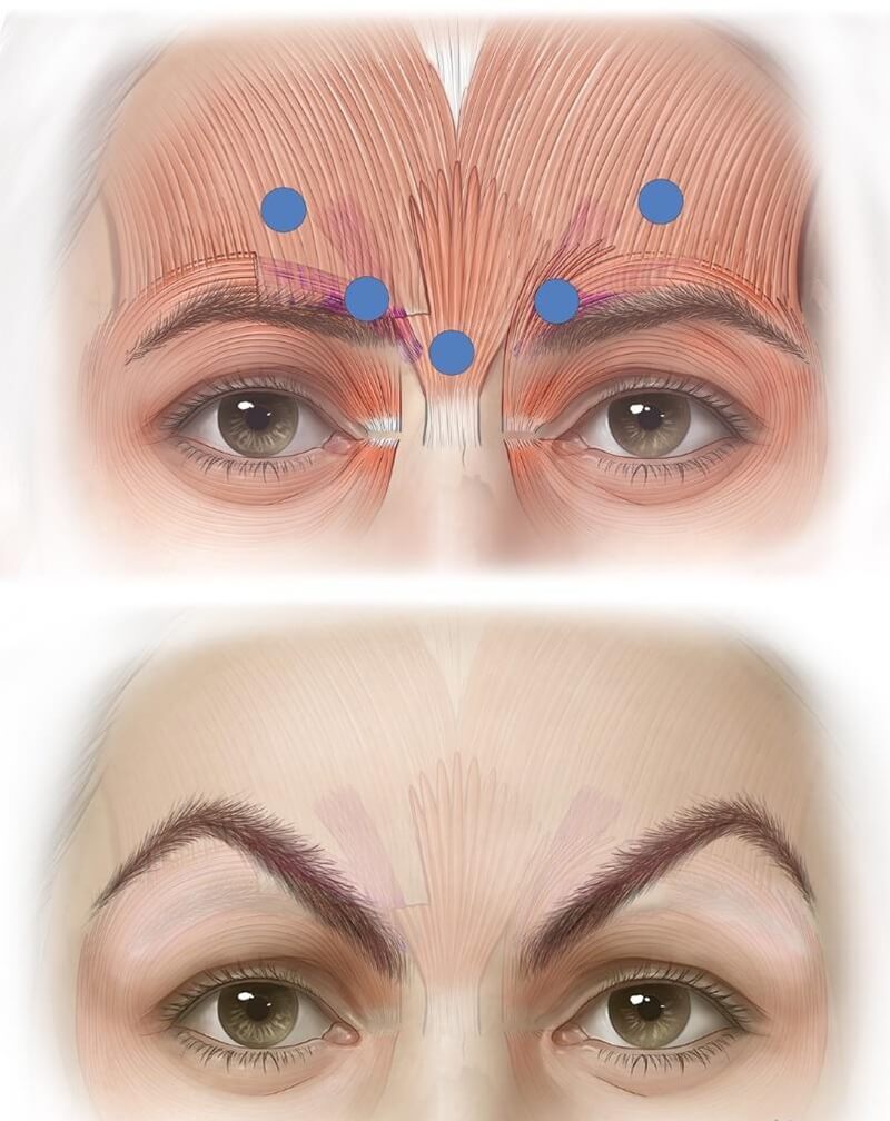 Mephisto effect due to high injection points
