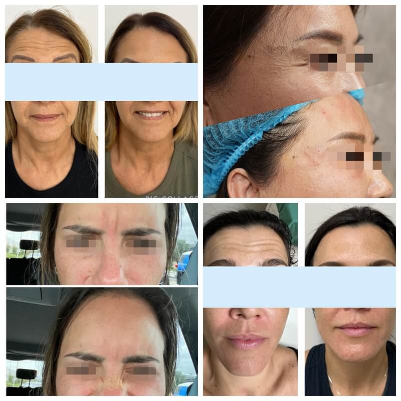 innotox 50 units botulinum toxin before and after