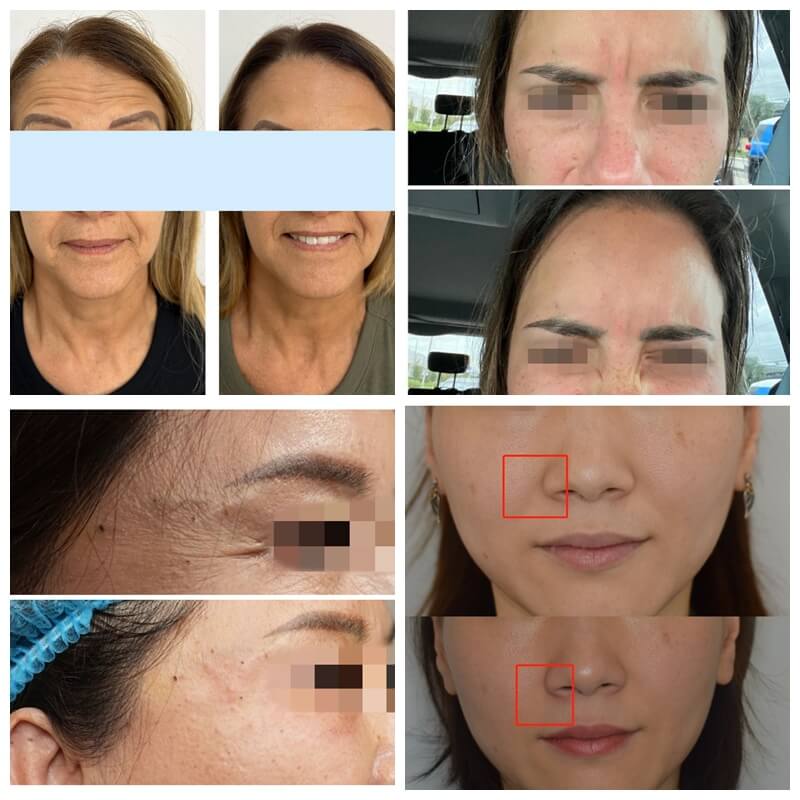 botulinum toxin for cosmetic purposes before and after