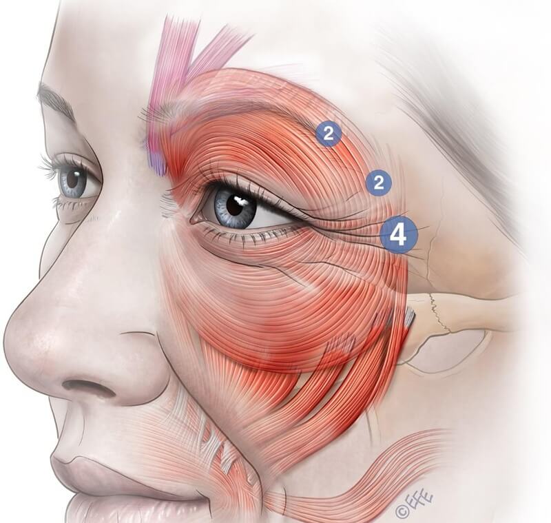 Avoiding step-off for Duchenne smile preservation