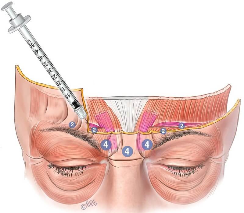 Tangential superficial injection technique