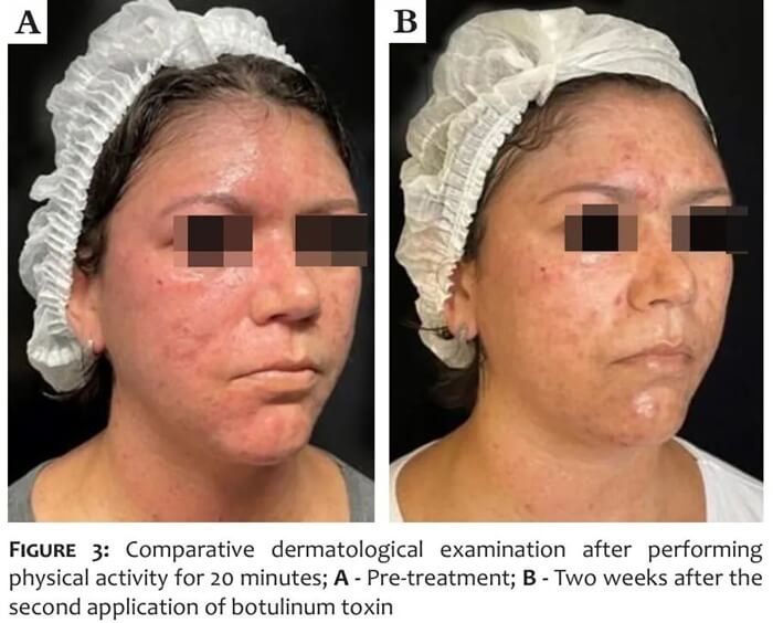 Harlequin syndrome treatment with botulinum toxin