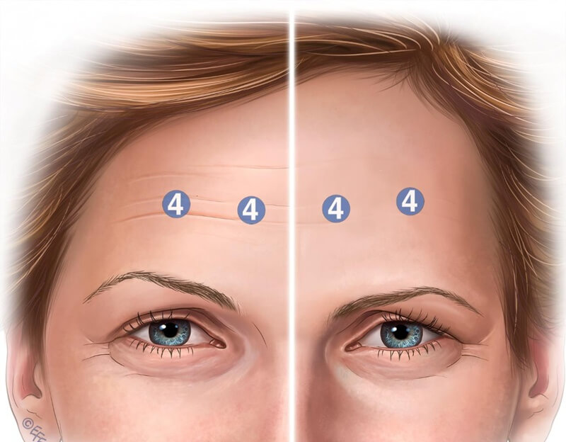 Glabellar injection sites and brow ptosis