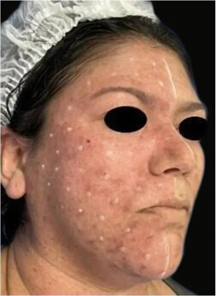 Harlequin syndrome treatment with botulinum toxin