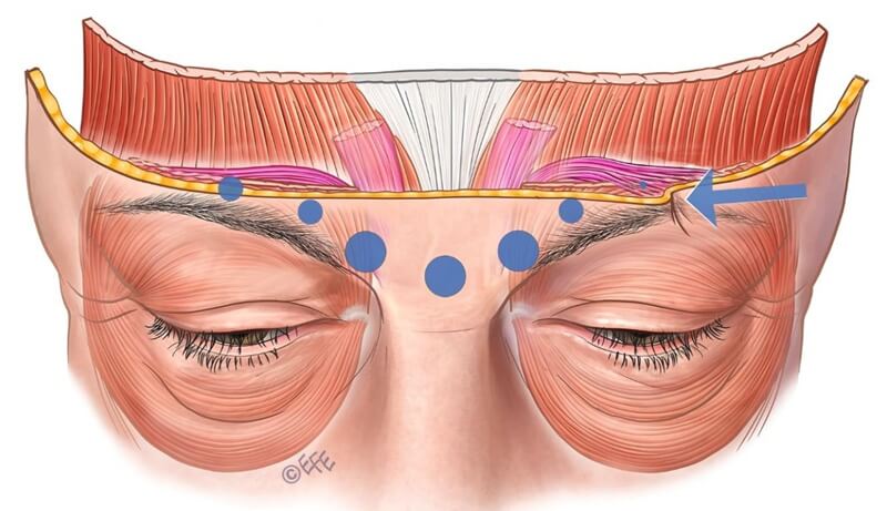 Residual activity from incomplete lateral injection