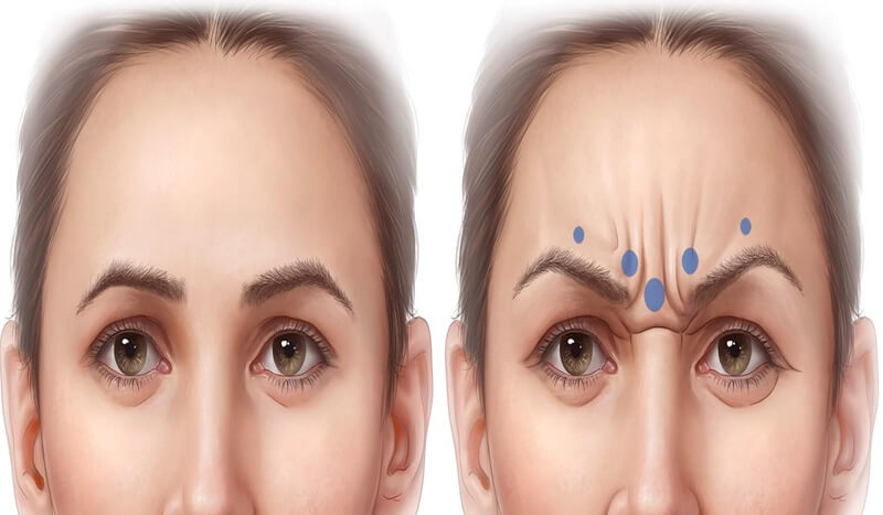U-shaped glabellar contraction