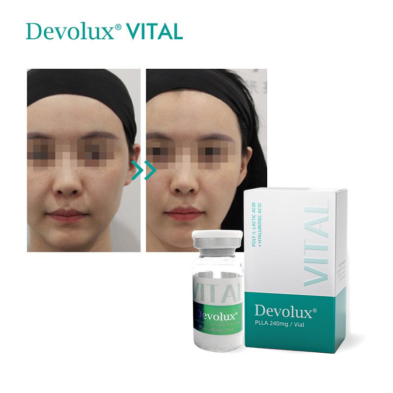 Devolux® Vital PLLA Dermal Filler Injection