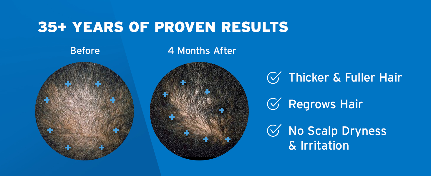 minoxidil, minoxidil treatment, hair growth, hair loss, hair regrowth, thinning hair, hair thinning