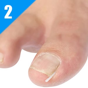 Ingrown toenail Correction