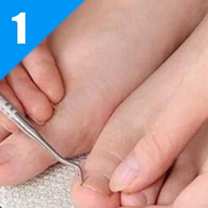  Ingrown toenail Correction
