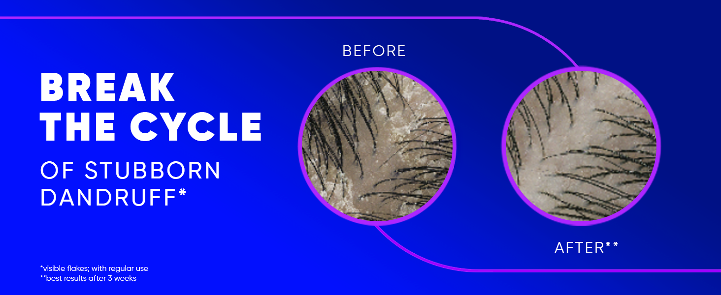 Break the cycle of stubborn dandruff