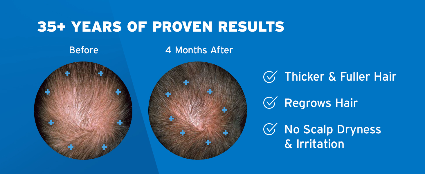 minoxidil, minoxidil treatment, hair growth, hair loss, hair regrowth, thinning hair, hair thinning