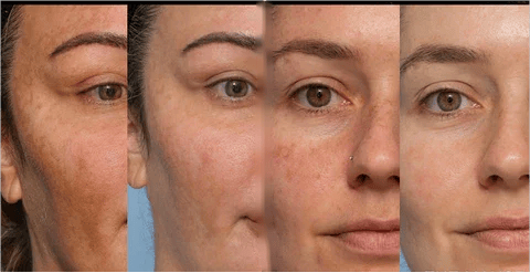 JEREMYTIS™ Herbal Spots Peel-Off Facial Mask