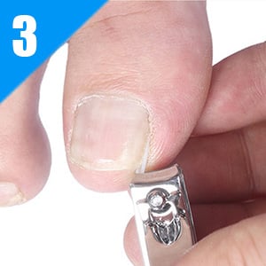 Ingrown toenail Correction